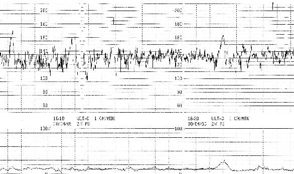 Tracciato cardiotocografico