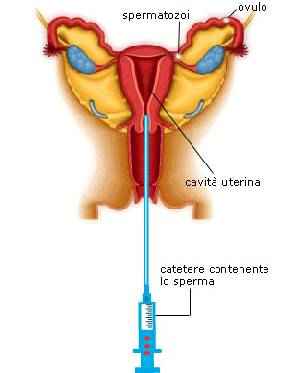 inseminazione intrauterina