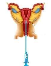 inseminazione intrauterina