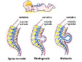 spina bifida