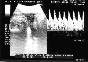 Flussimetria dell'arteria ombelicale